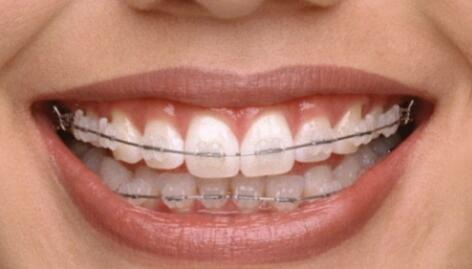 做牙冠的牙齿可以洗牙吗