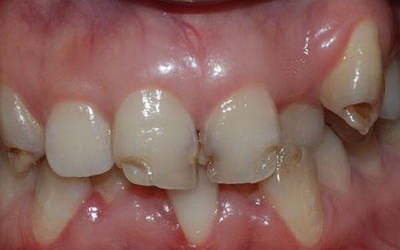 牙龈缝隙白色粘稠物(牙龈一按就从缝隙冒白色东西)