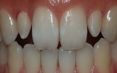 前门牙能做根管治疗吗