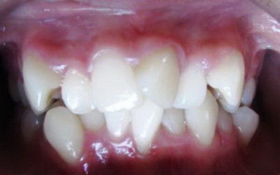 牙齿矫正需要拔4颗牙一次拔几颗(牙齿矫正需要多久去一次医院)