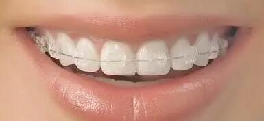 种植牙好还是固定牙好_固定牙和种植牙有什么区别