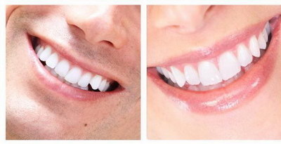 去除牙垢牙黄最简单的方法_只有一种方法可以清理牙垢