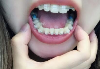 儿童换牙齿乳牙没掉新牙长出来