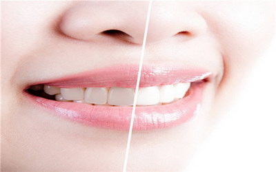 牙齿矫正有什么区别(4D牙齿矫正器和5D有什么区别)