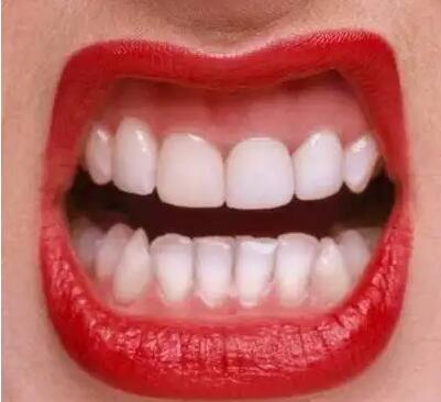 临时牙最多能戴多久