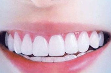 儿童透明牙齿矫正的好处和实施原理