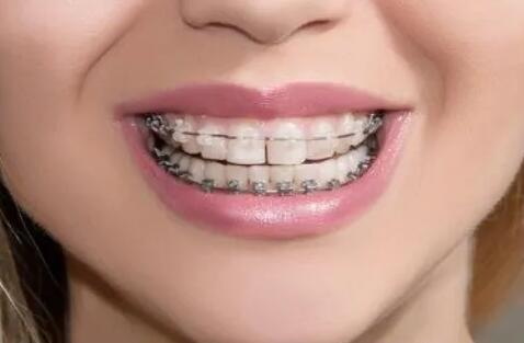 纯钛金属牙冠的优缺点_纯钛金属牙冠可以做核磁吗