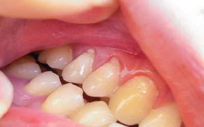 哺乳期可以做隐形牙齿矫正吗