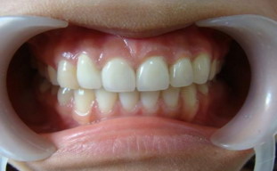 补牙一年后牙齿突然酸痛正常吗_补牙填充物掉了牙齿洞是黑色的