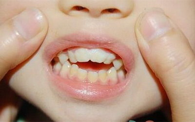 刷牙用力导致牙龈萎缩_全瓷牙会使牙龈萎缩吗