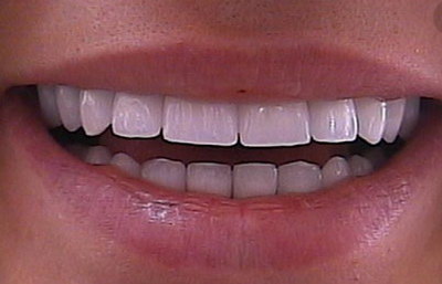 前牙松动能有什么方法固定_前牙咬合不上一定要矫正吗