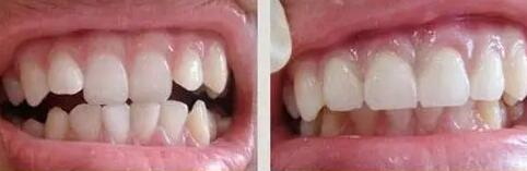 牙根管治疗后需要装牙套吗(牙根管治疗后是否需要装牙套？)