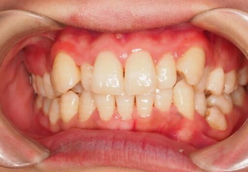 38岁矫正牙齿的后果