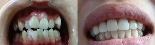 北大口腔医院矫正牙齿