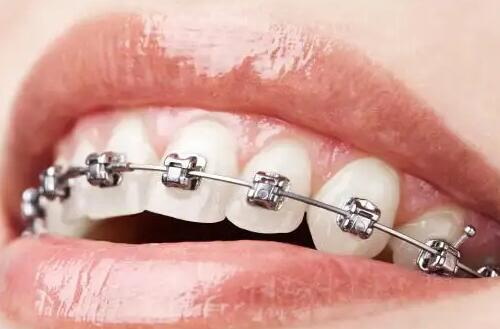 补牙后带牙套会把牙磨成什么样_补牙带牙套需要把对面的牙磨平吗