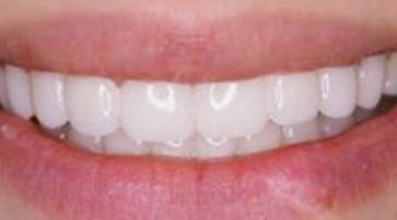 牙齿长期缺失的后果(长期牙齿缺失的后果)