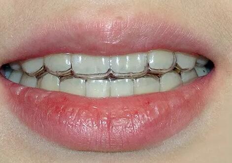 怎样预防牙龈萎缩