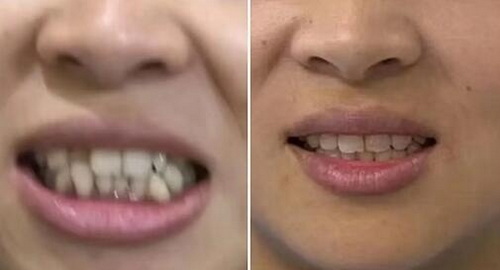 补牙后旁边牙齿偶尔麻_补牙会导致牙齿破裂吗