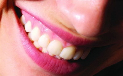 根管治疗后的牙套是什么样子的图片