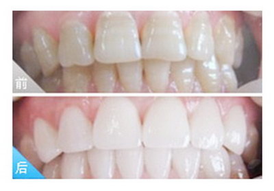 20岁拔牙后要镶牙还是种植牙_5000的种植牙能用几年