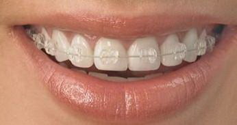 儿童牙齿沟窝封闭副作用「儿童牙齿涂氟的副作用」