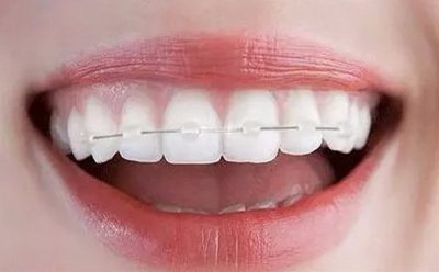 种植牙好还是固定牙好_固定牙齿:改善牙齿外观并提高口腔健康