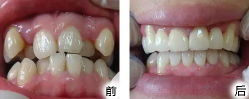 骨性龅牙牙齿矫正案例_骨性龅牙牙齿矫正多久能看到效果