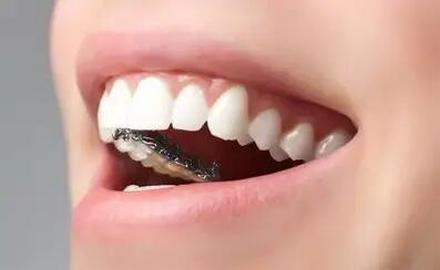 整牙可以整一颗门牙吗