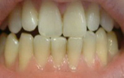 根管治疗一个月后牙疼怎么办_做根管治疗第二次上药后牙疼
