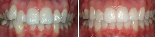 电动牙刷会对牙齿造成伤害吗_电动牙刷用久了牙齿会松动吗