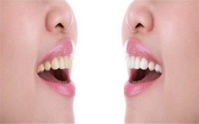 拔智齿后其他牙齿酸痛是什么原因_拔智齿后其他牙齿酸痛什么时候好