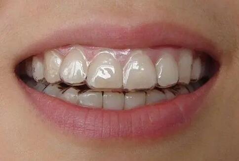 前牙美容修复术是什么_前牙美容修复牙体预备