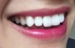 拔牙后牙洞里有黑色的线状物_拔牙后牙洞里有食物残渣不用弄出来会成为牙龈的一部分