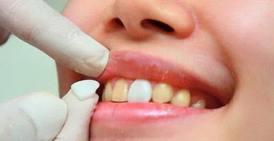 牙齿蛀牙补了能维持多久