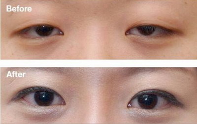 双眼皮要多久恢复正常_做过的双眼皮可以改吗