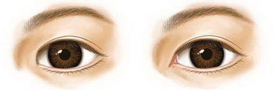 去眼袋手术和激光哪个好_去眼袋手术会留下疤痕吗