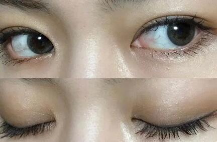 眼睑下垂手术几个月眼睛红肿(眼睑下垂手术几个月眼睑外翻)