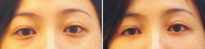 双眼皮埋线吃什么消炎药比较好_双眼皮埋线两个月两只眼不一样