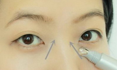 全切双眼皮多久能做修复_全切双眼皮多久伤口愈合