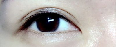 双眼皮修复多长时间恢复_双眼皮修复的原理是什么