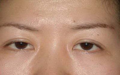 做完双眼皮手术快速消肿的方法