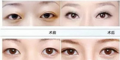 割双眼皮后的注意事项保养方法_割双眼皮后的注意事项是什么