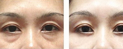 双眼皮修复有什么风险_北京的双眼皮修复专家