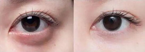 双眼皮增生前兆是什么症状表现
