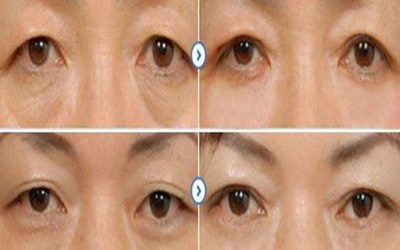 南京修复双眼皮最好的医生