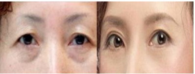 抽脂埋线双眼皮两个月拆线_抽脂埋线双眼皮能维持几年