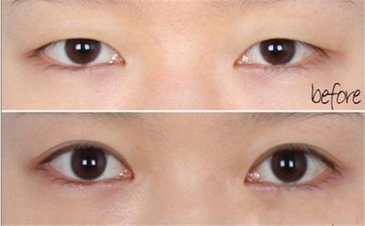 欧式大平行双眼皮案例(欧式和大平行双眼皮)