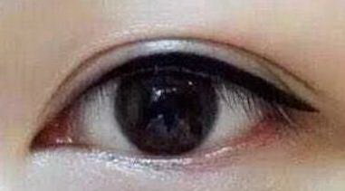 双眼皮术后眼皮发紫_双眼皮术后伤疤增生