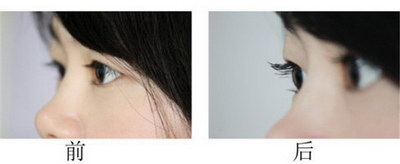 单眼皮双眼皮基因分析_单眼皮双眼皮区别