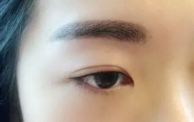 大连双眼皮切割手术介绍_韩式定点双眼皮是永久的吗